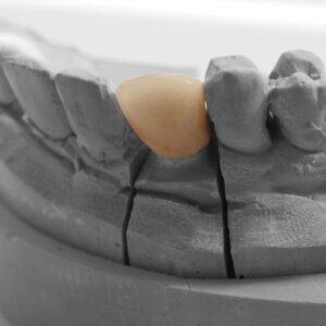 https://www.sivpdental.it/wp-content/uploads/2023/03/Couronne-ceramo-metallique-300x300.jpeg