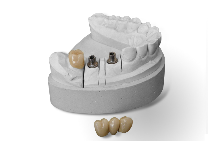 https://www.sivpdental.it/wp-content/uploads/2023/04/PROTHESES-SUR-IMPLANT.png
