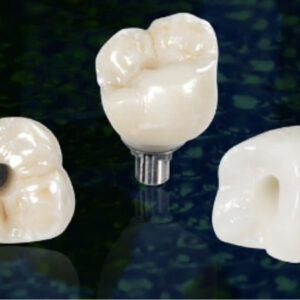 https://www.sivpdental.it/wp-content/uploads/2023/05/Couronne-transvissee-sur-implant-300x300.jpg